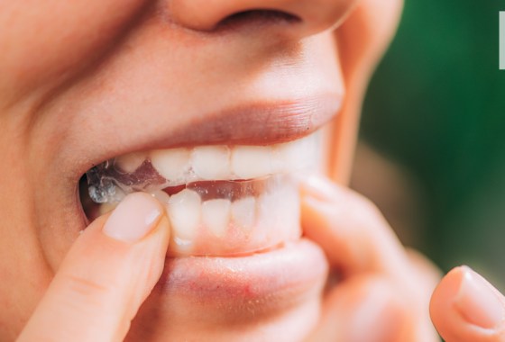 Teeth whitening kits vs. strips: Which should I get?